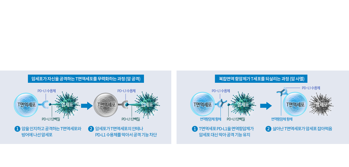 복합면역세포치료
